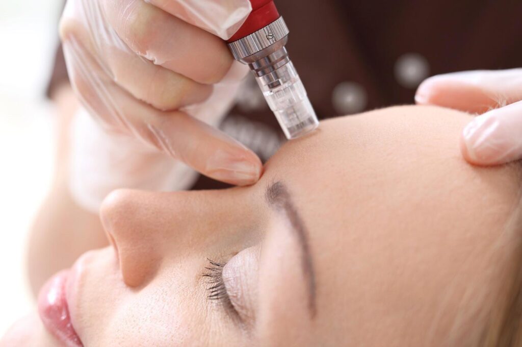 Mesotherapy Treatment in London